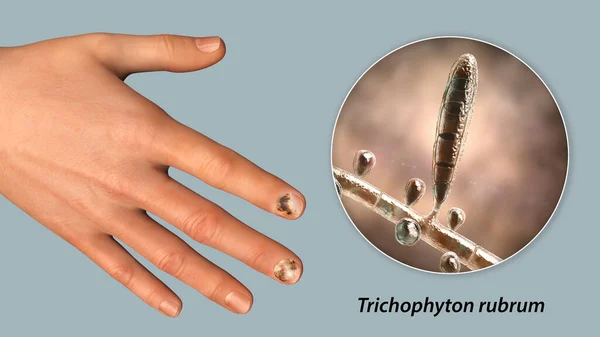 Human Hand Onychomycosis Close View Trichopyton Rubrum Fungi One Causative — Stock Photo, Image