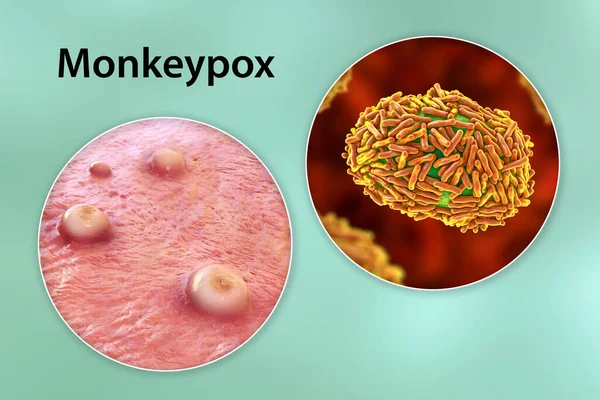Skin Lesions Monkeypox Infection Close View Monkeypox Virus Illustration Zoonotic — Stock Photo, Image
