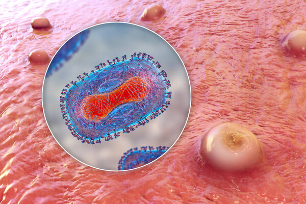 Skin lesions in monkeypox infection and close-up view of monkeypox virus, 3D illustration. A zoonotic virus from Poxviridae family, causes monkeypox, a pox-like disease