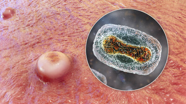 Skin lesions in monkeypox infection and close-up view of monkeypox virus, 3D illustration. A zoonotic virus from Poxviridae family, causes monkeypox, a pox-like disease