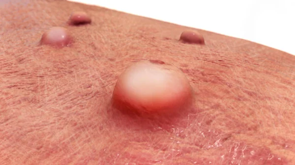 Lesões Cutâneas Varíola Varíola Molusco Contagioso Outras Infecções Pelo Vírus — Fotografia de Stock