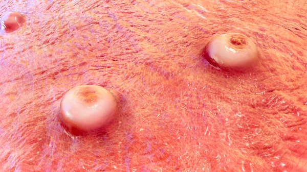 Lesões Cutâneas Varíola Varíola Molusco Contagioso Outras Infecções Pelo Vírus — Fotografia de Stock