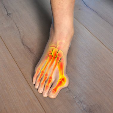 Ayak parmağı deformasyonu, hallux valgus ya da nasır olarak da bilinir. Üç boyutlu çizimler, ayak parmaklarında şişlik ve deforme olmuş ayak kemikleri ile işaretlenmiş iskelet olduğunu gösteriyor.