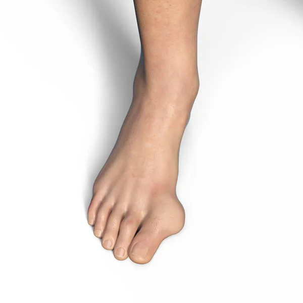 脚趾变形 也被称为Hallux Valgus 或Bunion 3D图解 — 图库照片