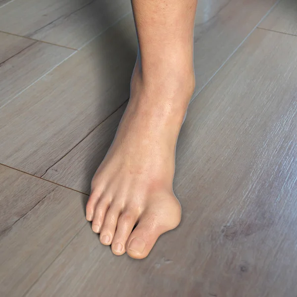 Ayak Parmağı Deformasyonu Hallux Valgus Olarak Bilinir Nasır Boyutlu Illüstrasyon — Stok fotoğraf