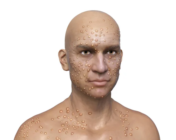 Man Skin Boils Caused Pox Virus Illustration Smallpox Monkeypox Other — Stock Photo, Image