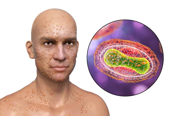 Man Skin Boils Caused Pox Viruses Close View Virus Illustration — Stock fotografie