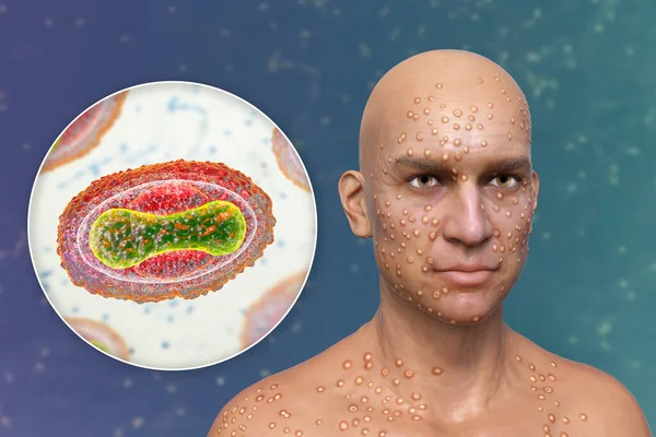 Man Skin Boils Caused Pox Viruses Close View Virus Illustration — Photo