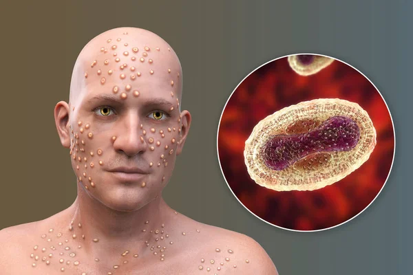 A man with skin boils caused by pox viruses and close-up view of the virus, 3D illustration. Smallpox, monkeypox and other pox virus infections