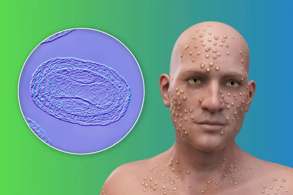 Man Skin Boils Caused Pox Viruses Close View Virus Illustration — Stockfoto