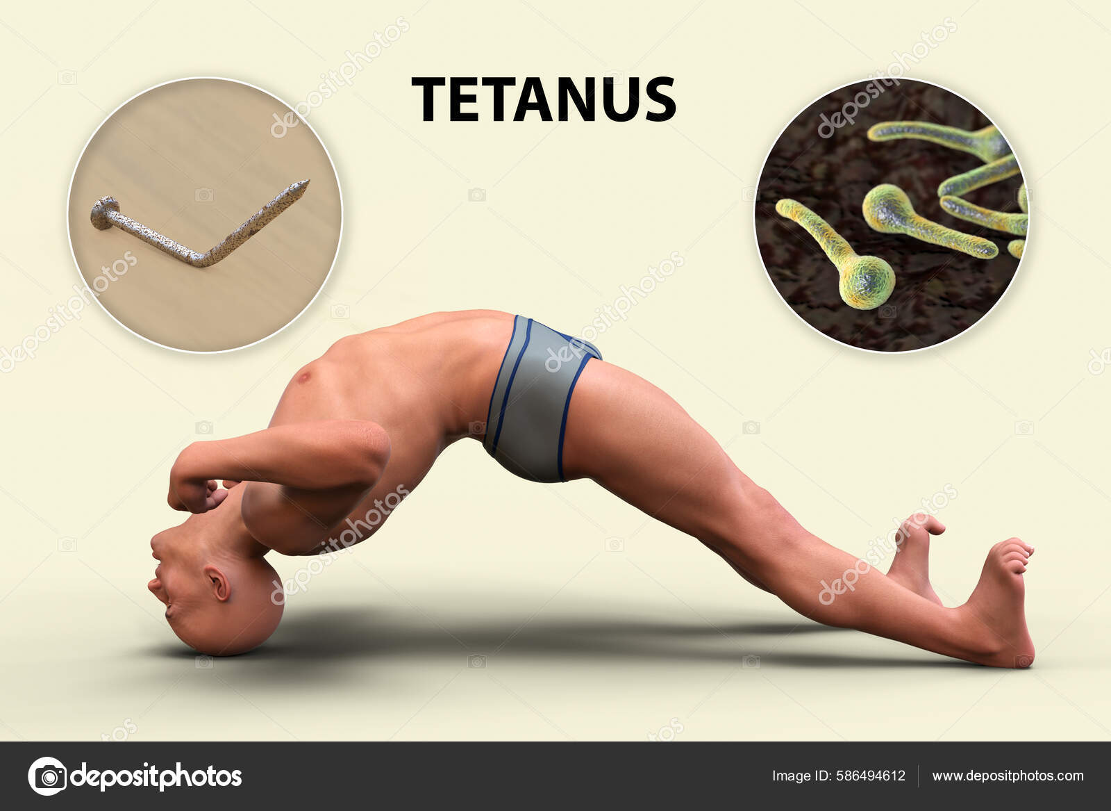 Opisthotonus Man Suffering Tetanus Bacteria Clostridium Tetani Rusty