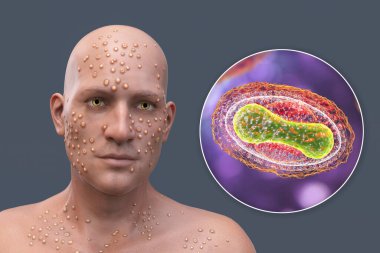 A man with skin boils caused by pox viruses and close-up view of the virus, 3D illustration. Smallpox, monkeypox and other pox virus infections