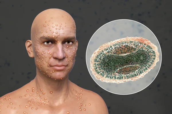 Muž Kožní Vředy Způsobené Neštovicemi Viry Detailní Pohled Virus Ilustrace — Stock fotografie