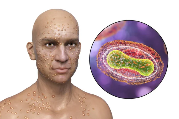 Man Skin Boils Caused Pox Viruses Close View Virus Illustration — Stock fotografie