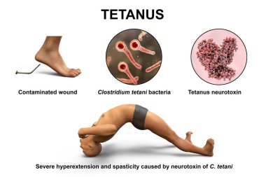 Mechanism of tetanus disease, 3D illustration. A skin wound is contaminated with Clostridium tetani bacteria that produce neurotoxin reaching the spinal cord and causing spastic paralysis
