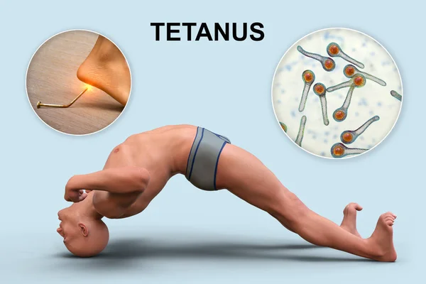 stock image Mechanism of tetanus disease, 3D illustration. A skin wound is contaminated with Clostridium tetani bacteria that produce neurotoxin reaching the spinal cord and causing spastic paralysis