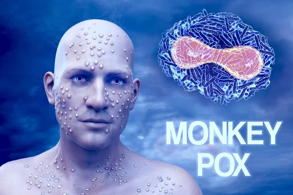 The newly emerging monkeypox disease, conceptual 3D illustration. A patient with monkeypox and close-up view of monkeypox virus, a zoonotic virus from Poxviridae family, causes a pox-like disease