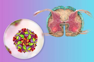 Felç edici çocuk felci hastalığı mekanizması. Omuriliğin ön boynuzunun motor nöronlarını etkileyen çocuk felci virüsleri, kavramsal 3 boyutlu illüstrasyon.