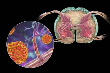 Felç edici çocuk felci hastalığı mekanizması. Omuriliğin ön boynuzunun motor nöronlarını etkileyen çocuk felci virüsleri, kavramsal 3 boyutlu illüstrasyon.