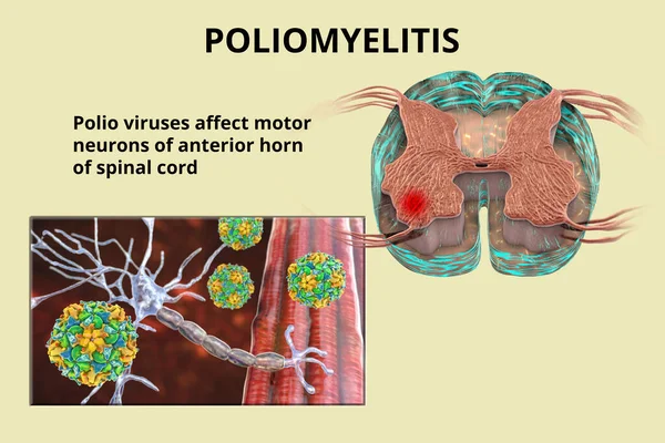 Mekanism För Paralytisk Polio Sjukdom Poliovirus Som Påverkar Motorneuroner Främre — Stockfoto