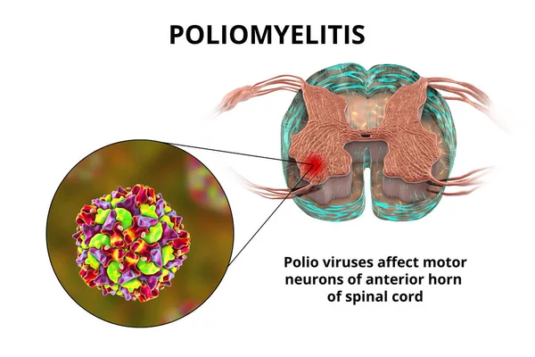 Mecanismo Poliomielitis Paralítica Virus Poliomielitis Que Afectan Las Neuronas Motoras — Foto de Stock