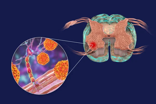 瘫痪性小儿麻痹症的发病机制 影响脊髓前角运动神经元的小儿麻痹症病毒 概念三维说明 — 图库照片