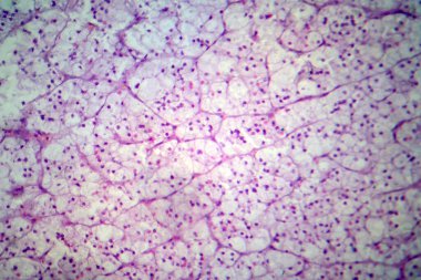 Adrenokortikal adenom, ışık mikrografı, mikroskop altında fotoğraf. Adrenal korteksin hücrelerinden çıkan iyi huylu tümör.
