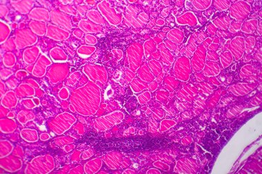 Basit guatr, hafif mikrograf, mikroskop altında fotoğraf. Tiroid bezinin büyümesi. Basit bir guatrın en yaygın nedeni iyot eksikliğidir.