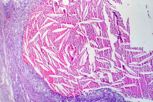 Karsinoma Folikular Tiroid Mikrograf Cahaya Foto Bawah Mikroskop — Stok Foto