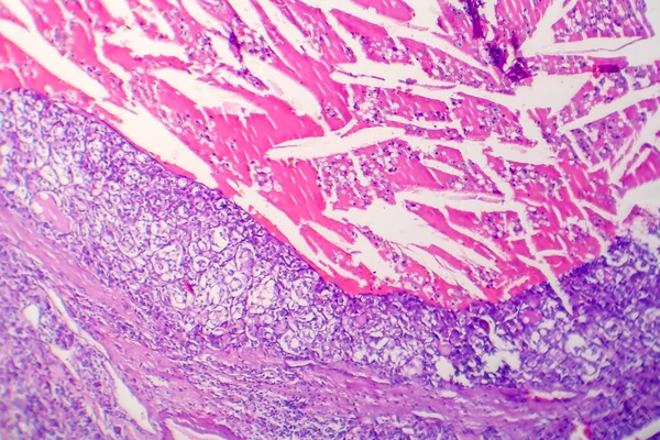 Carcinoma Folicular Tiroideo Micrografía Ligera Foto Bajo Microscopio — Foto de Stock