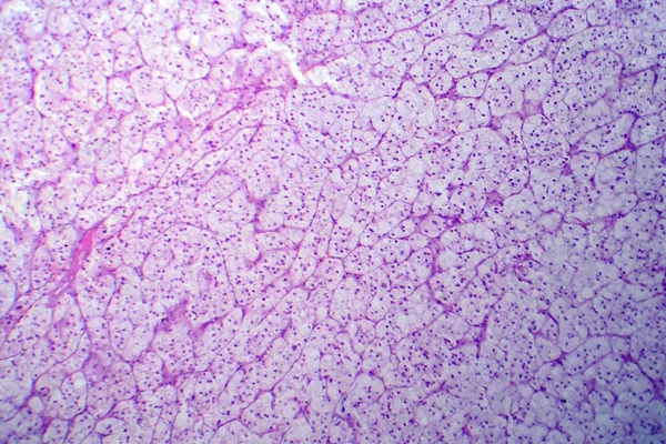 Adrenocorticaal Adenoom Lichtmicrograaf Foto Onder Microscoop Goedaardige Tumor Die Ontstaat — Stockfoto