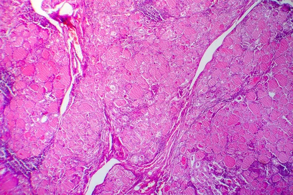 Bocio Simple Micrografía Ligera Foto Bajo Microscopio Ampliación Glándula Tiroides — Foto de Stock