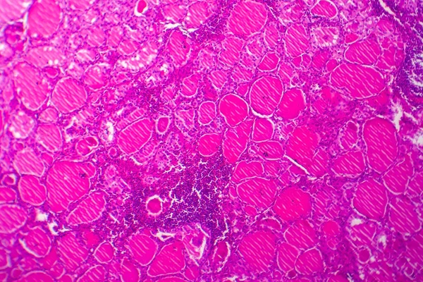 Simple Goitre Micrographie Lumineuse Photo Microscope Elargissement Glande Thyroïde Cause — Photo
