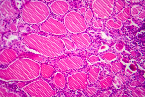 Simple Goitre Micrographie Lumineuse Photo Microscope Elargissement Glande Thyroïde Cause — Photo