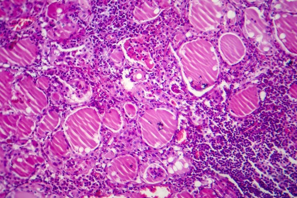単純なゴイター ライトマイクログラフ 顕微鏡下の写真 甲状腺の拡大 単純なゴイターの最も一般的な原因はヨウ素欠乏である — ストック写真