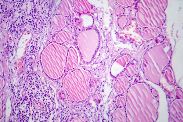 Tiroidite Fibrosa Microscopio Leggero Foto Microscopio Una Malattia Caratterizzata Infiammazione — Foto Stock