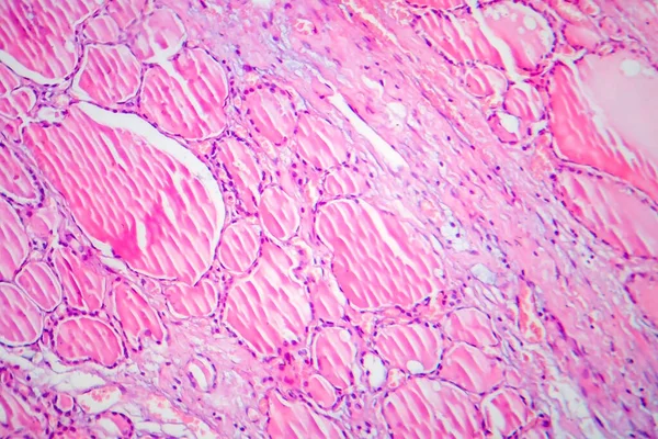 Tiroiditis Fibrosa Micrografía Ligera Foto Bajo Microscopio Enfermedad Caracterizada Por — Foto de Stock