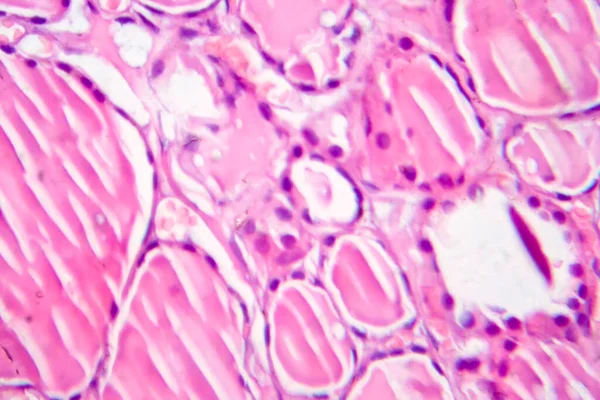 Tiroiditis Fibrosa Micrografía Ligera Foto Bajo Microscopio Enfermedad Caracterizada Por — Foto de Stock