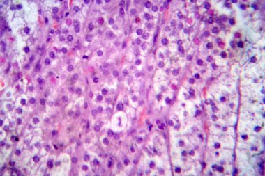 Adrenokortikal adenom, ışık mikrografı, mikroskop altında fotoğraf. Adrenal korteksin hücrelerinden çıkan iyi huylu tümör.