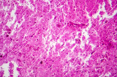 Menenjit, hafif mikrograf, mikroskop altında fotoğraf.