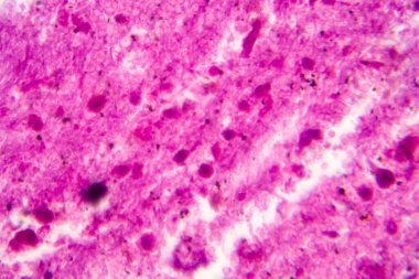 Menenjit, hafif mikrograf, mikroskop altında fotoğraf.