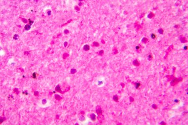 Menenjit, hafif mikrograf, mikroskop altında fotoğraf.