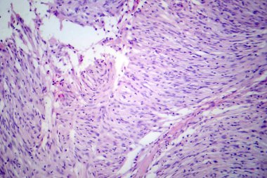 Menenjiyom, yavaş büyüyen bir tümör. Menenjitlerden, mikroskop altında çekilmiş bir fotoğraf.