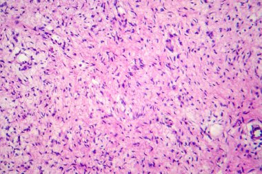 Nörofibromatoz, hafif mikrograf, mikroskop altında fotoğraf. Sinir sisteminde tümör oluşumu olan bir grup genetik bozukluk.