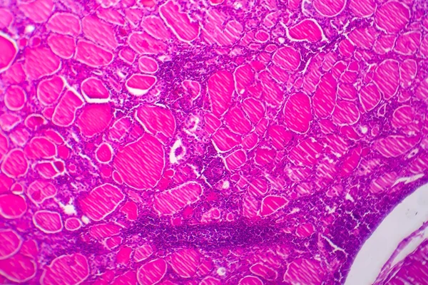 현미경으로 사진을 수있습니다 갑상샘 갑상선종의 원인은 요오드 결핍증이다 — 스톡 사진