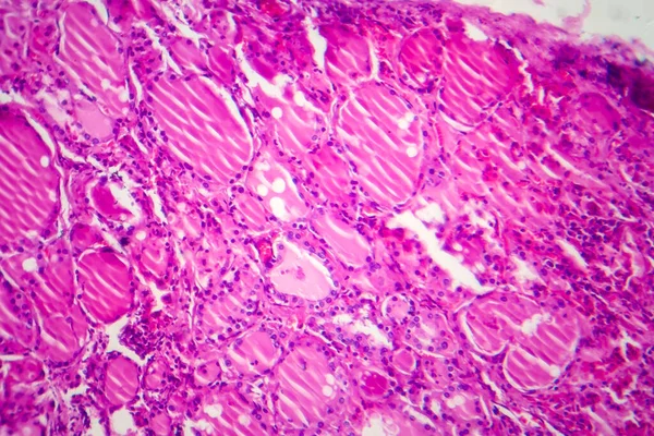 単純なゴイター ライトマイクログラフ 顕微鏡下の写真 甲状腺の拡大 単純なゴイターの最も一般的な原因はヨウ素欠乏である — ストック写真