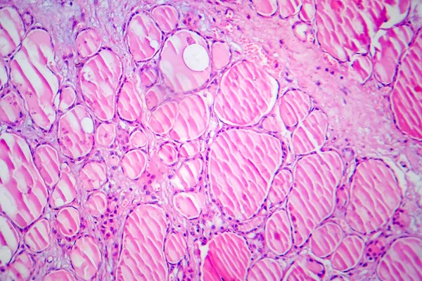 Tireoidite Fibrosa Micrografia Luz Foto Sob Microscópio Uma Doença Caracterizada — Fotografia de Stock