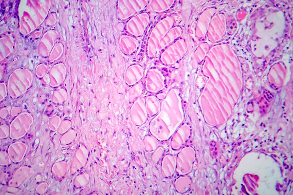 Tiroiditis Fibrosa Micrografía Ligera Foto Bajo Microscopio Enfermedad Caracterizada Por — Foto de Stock