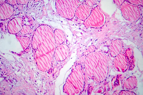 線維性甲状腺炎 光マイクログラフ 顕微鏡下の写真 甲状腺の慢性炎症や線維化を特徴とする疾患 — ストック写真