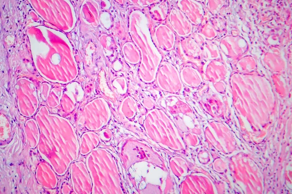 Vezelachtige Schildklierontsteking Lichtmicrograaf Foto Onder Microscoop Een Ziekte Gekenmerkt Door — Stockfoto